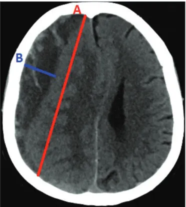 Figure 1: An acute onset chronic subdural hematoma case: The 