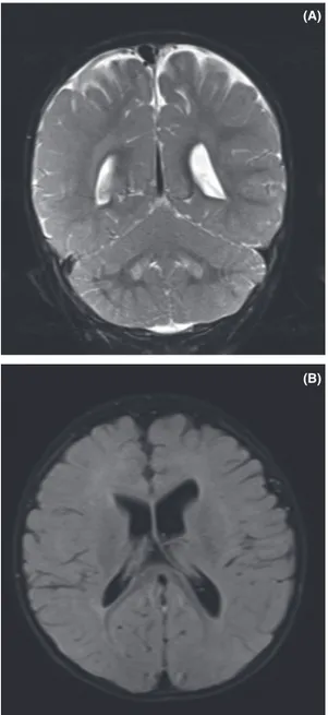 Figure 3. Magnetic resonance imaging: (A) Hyperintensity at bilateral dentate nucleus