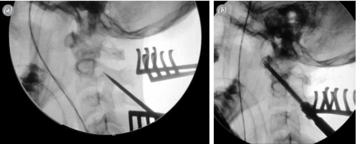 Fig. 3.  (a) Perioperative fluoroscopy image; after knotting of laminas, the dislocation is reduced and screwing is securely  made
