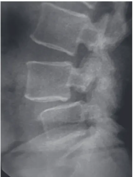 Fig. 2.  Lateral (sagittal) lumbar vertebral  computed tomography scan reveals the  lysthetic segment at L4–L5 level.
