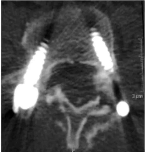 Fig. 6 . The laminae 3 months after replacement viewed in  an axial lumbar vertebral computed tomography scan.