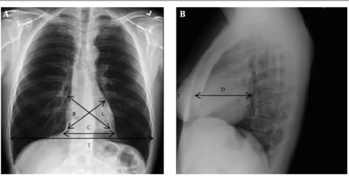 Figure 2. The measurements of cardiothoracic ratio, cardiac area, and cardiac volume are shown on posteroanterior (A) and lateral (B) chest X-Rays
