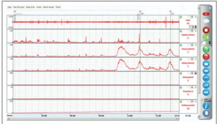 Figure 1:  Normal urodynamic test Figure 2:  This urodynamic test resulted extremely active detrusor 