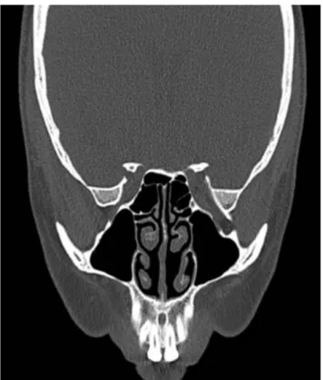 Figure 1. Paranasal sinus tomography. Preserved integrity of na- na-sal conchae with a perforation in the posterior part of the inferior nasal concha.