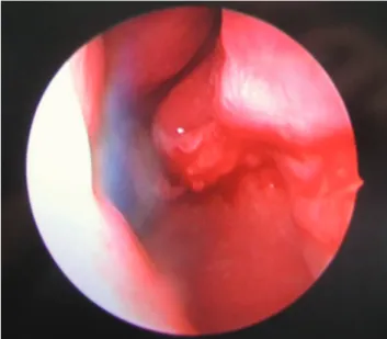 Figure 3. Disintegration of perforation under rigid endoscopy– directed surgery.