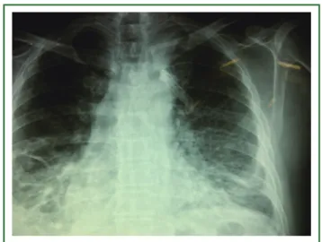 Figure 1. JP drain inserted through an anterior approach in a patient 