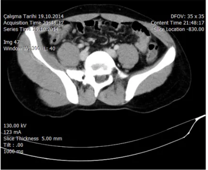 Figure  2:  Mesenteric  lenfadenitis  in  right  lower  quadrant  of  the  abdomen  in  intravenous contrast enhanced abdominopelvic computerized tomography 