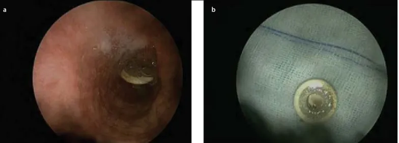 Figure 1. a, b. Aspirated bone piece in the entry of the right lower lobe bronchus (a); formation of minimal granulation around it (b)