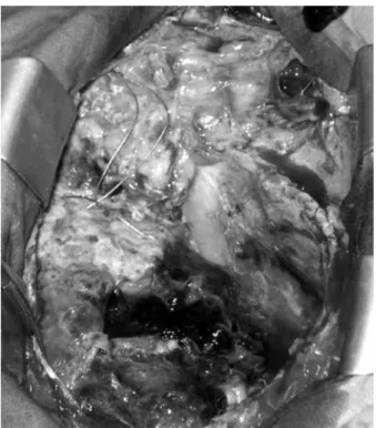 Figure 1. Intraoperative view of the mediastinum at surgical 