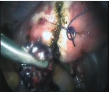 Figure 1.  Cornual (interstitial) pregnancy before laparoscopy Figure 2.  The intraabdomial view after laparoscopy