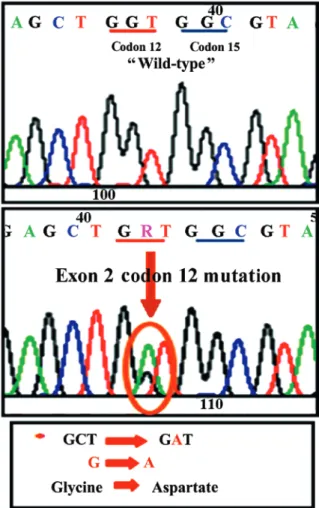 Figure 1. Representative image of a mutation detected by direct sequencing  analysis. Glycine was replaced by aspartate in codon 12 of exon 2 in the  K‑Ras gene.