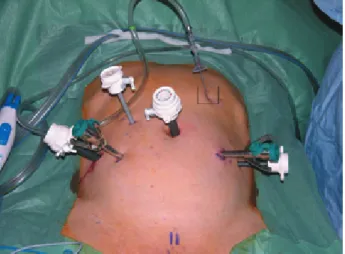 Figure 2. Port placement for robotic radical prostatectomy with 