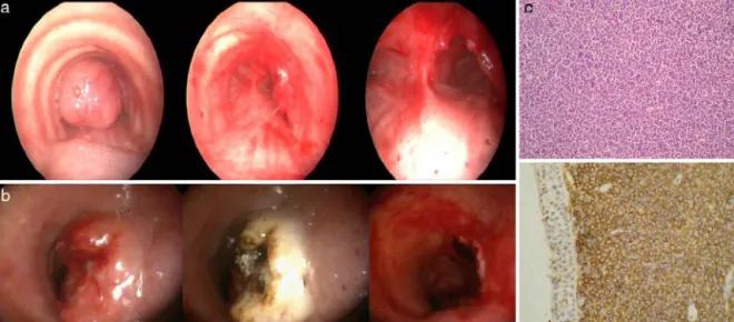 Fig. 1. (a and b) Bronchoscopy view before and after the interventions. (c) Immunohistochemical staining of a tracheal tumor showing large B-cell lymphoma.