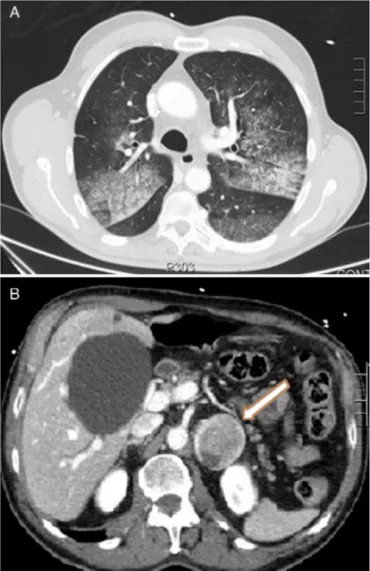 Fig. 1. (A) CT axial image showing crazy-paving lung pattern: ground-glass consoli-