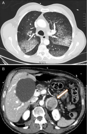 Fig. 1. (A) CT axial image showing crazy-paving lung pattern: ground-glass consoli-