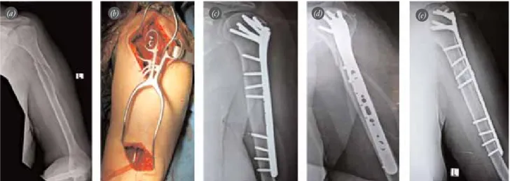 Fig. 2. Views of 82-year-old female patient. (a) Type 11A1 and 12C12 fractures are seen