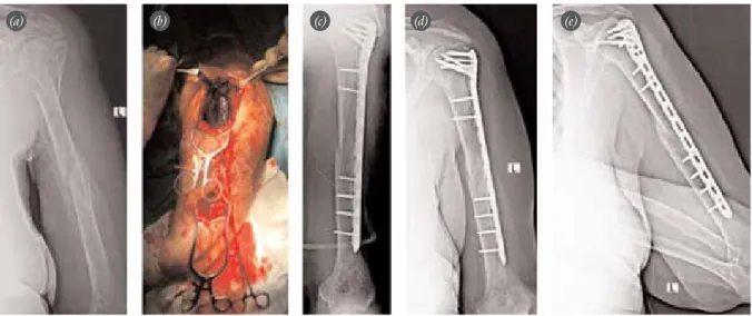 Fig. 4. Views of 70-year-old female patient. (a) AO Type 11B2 and 12C22 fractures. (b) Surgical intervention