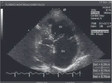 Şekil 2. Pulmoner hipertansiyonu olan bir hastada apikal 4 boşluk ekokardiyo- ekokardiyo-grafik görüntüde genişlemiş  sağ kalp boşlukları