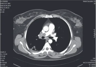Şekil 5. Pulmoner embolili bir hastada toraks BT’ de akciğerde pulmoner  infarkt görüntüsü (Florence Nightingale Hastanesi Radyoloji arşivi’ nden  alınmıştır) 