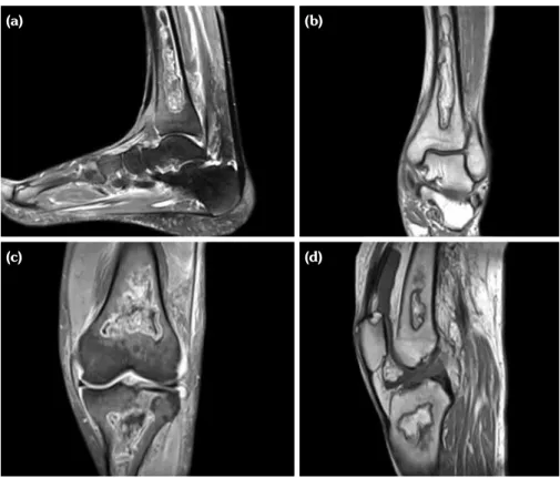 Figure 1. Magnetic resonance imaging of left ankle and left knee. (a) Sagital fat  suppressed T 2 -weighted image and (b) coronal T 1 -weighted image of left ankle