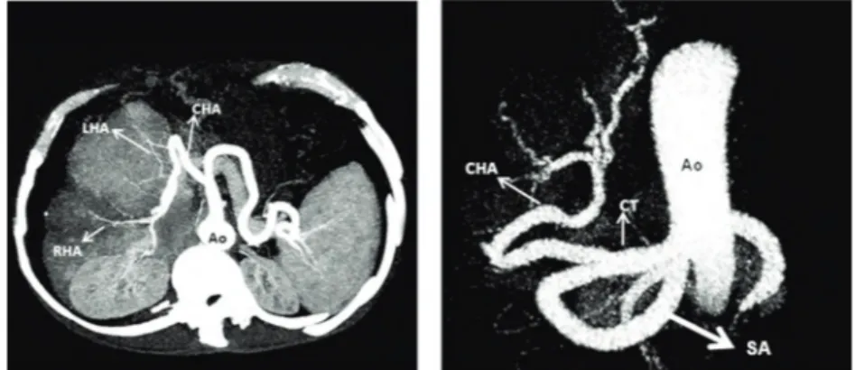 Figure 1. A 46-year-old man who was a liver transplantation candidate. A, Axial MIP image and B, 3D Volume-rendered images show all arterial structures (celiac, common hepatic, hepatic propia, and bilateral hepatic artery) well