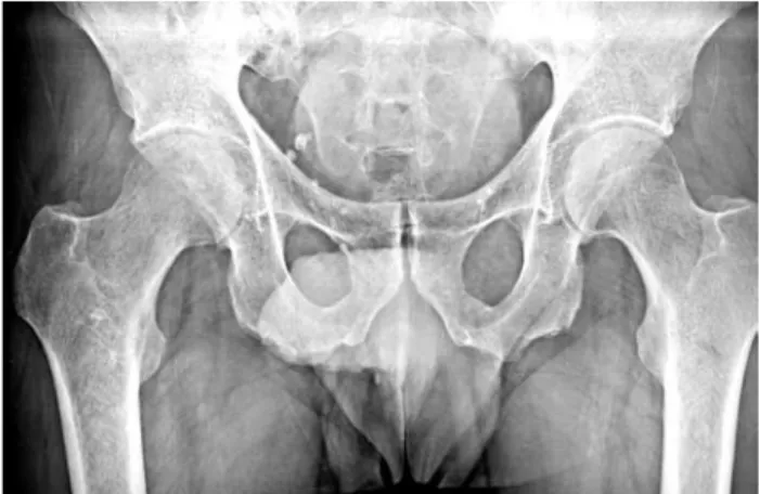 Table 1. Steinberg Classification for the osteonecrosis of femoral head  [8]