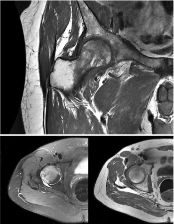 Figure 3. Core decompression and autologous mononuclear bone marrow cell implantation performed