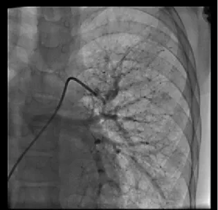 Fig. 3. Aortagram showing fully expanded covered CP stent. Fig. 4. Angiogram of right pulmonary artery after occlusion  of PAVM with amplatzer vascular plug I and II