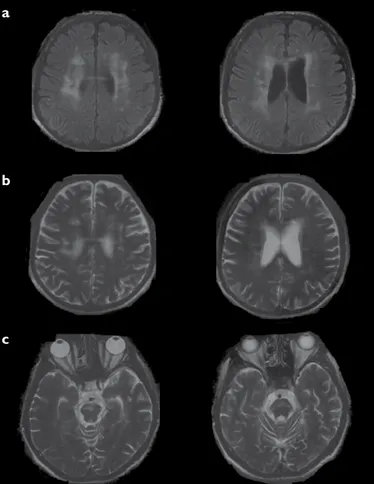 Figure 1. a-c. Axial FLAIR and T2 images of a patient diagnosed with NB disease.  (a) Bilateral white matter lesions in centrum semiovale and in corpus callosum are  shown and lateral ventricular atrophic dilatation can be seen on FLAIR image