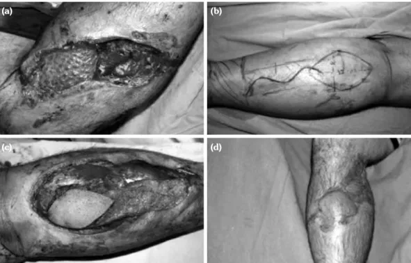Table 2. Indications for free flap reconstruction for lower  extremity tissue defects
