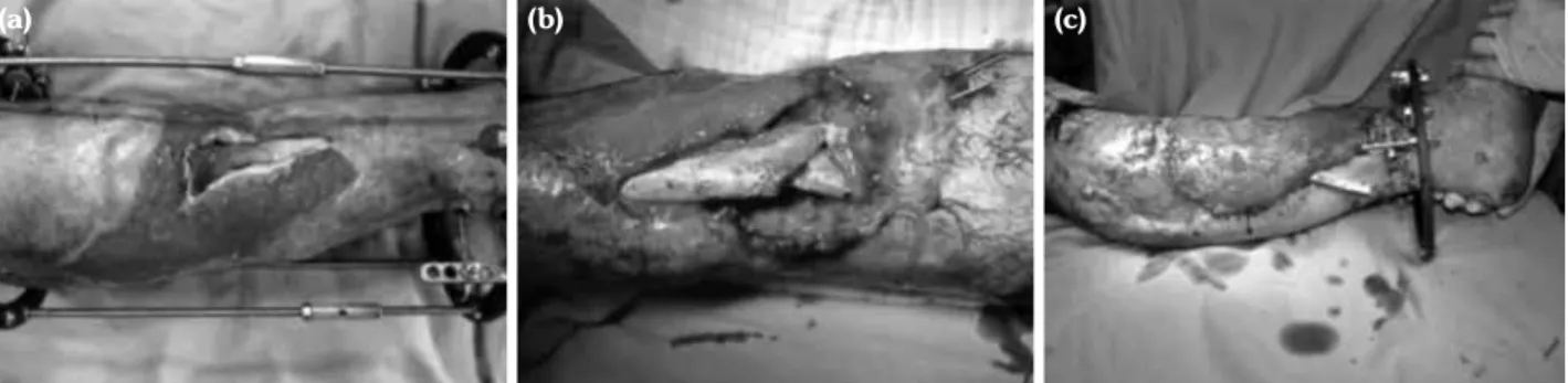 Figure 6. (a) A 22-year-old male suffered a traffic accident. He had an open tibia fracture