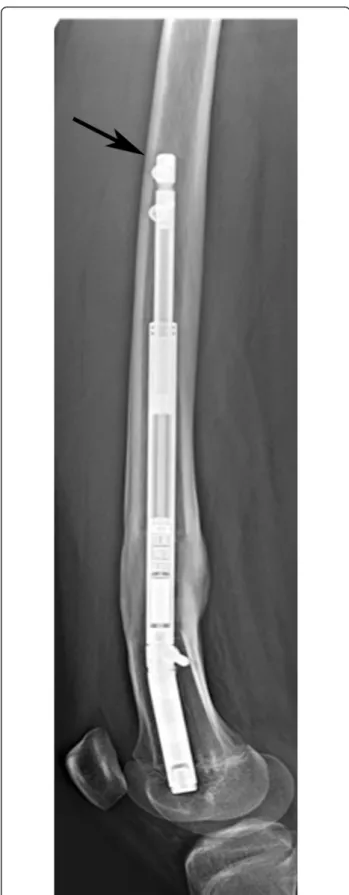 Fig. 1 Lateral X-ray showing nail tip impingement on the anterior cortex in the proximal femur