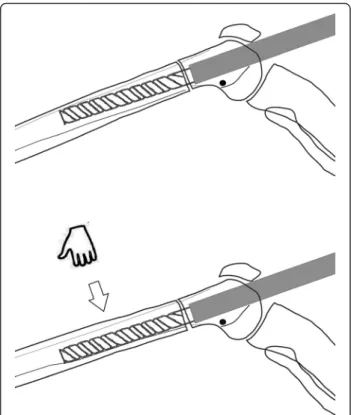 Fig. 4 Preoperative planning of femoral lengthening using the CorelDRAW® Graphic Suite X6 software