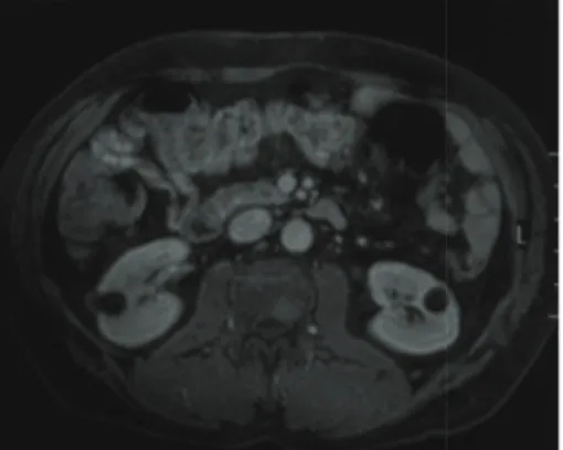 Figure 4: The biopsy specimen of the right femoral lesion showed diffuse neoplastic infiltration consisting of cells with round, oval, regular nuclei, and medium-sized, clear cytoplasm (H&amp;E, ×400).