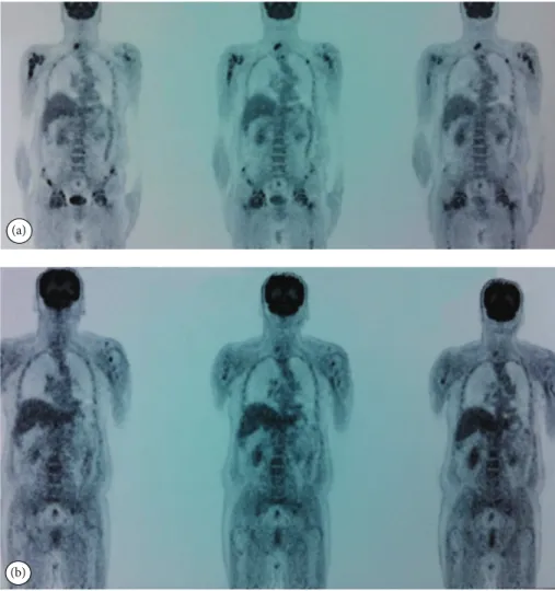 Figure 6: PET scan at diagnosis and 8 weeks after chemotherapy. (a) There was increased FDG uptake on axial skeleton, pelvis, and both femurs at diagnosis