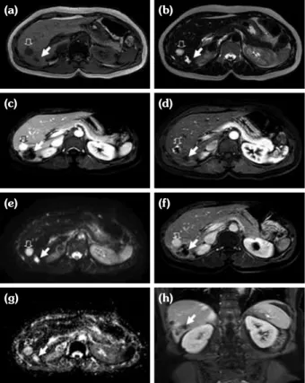 Figure 1. On contrast enhanced computed tomography  images [arterial phase (a, b), venous phase (c-e),  delayed contrasted image (f)] show non-filling peripheral  enhanced, subcapsular and central localized hypodense  tubular-tortuous lesions in the right 