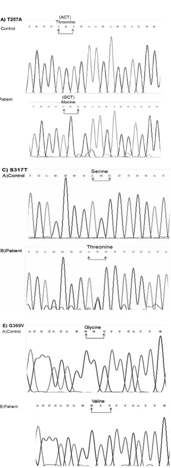 Figure 2. Determination of missense GHRHR gene mutations.  Sequence analysis of A) T257A Mutation, Normal person carries  Threonine (T) amino acid residues on position 257 in GHRHR gene  encoded by ACT