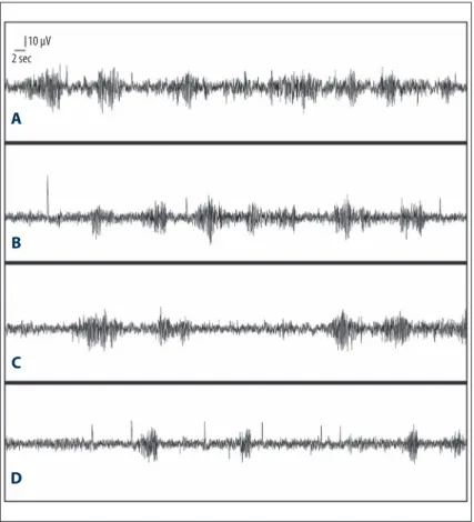 Figure 1.   EEG recording ( A ): PTZ (35 mg/kg) and  saline, ( B ): PTZ (35 mg/kg) and 25 mg/ kg montelukast group; ( C ): PTZ (35  mg/kg) and 50 mg/kg montelukast  group; ( D ): PTZ (35 mg/kg) and 100  mg/kg montelukast group.10 µV2 sec A B C D