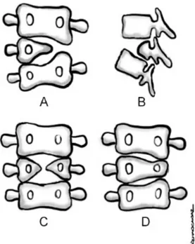 Figure 1  - Illustrating defects of formation. A. Lateral  hemivertebrae. B. Dorsal hemivertebrae