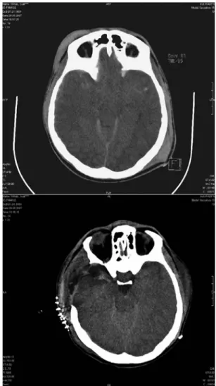 Figure 2. A. Preoperative computerized tomography shows  transtentorial herniation. Note obliteration of the basal  cis-terns, medial displacement of the medial temporal lobe,  dis-tortion of the brain stem, and dilatation of the contralateral  temporal ho