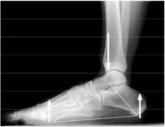 Şekil 2: Medial longitüdinal ark ve plantar fasyanın oluşturduğu temsili üçgen (15)         