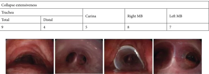 Table 3. Patient clinical characteristics. Right MB: right main bronchus. Left MB: left main bronchus.