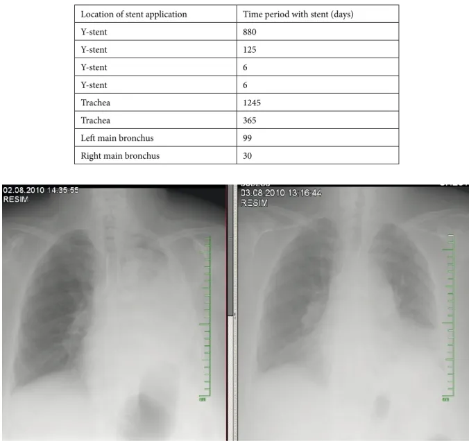 Figure 3. Patient’s radiograph before and after mucostasis cleaning.