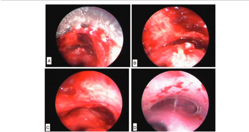 Figure 2. (A) A 54-year-old patient with internal and external tracheal tumoral compression who presented with respiratory insufﬁciency and tracheal lumen was obstructed >90%