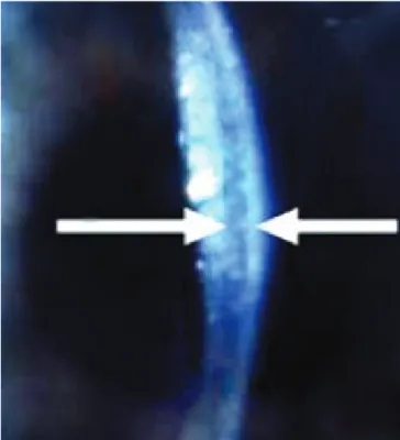 Figure 1: Diffuse lamellar keratitis DLK- like appearance.  Figure 2: Slit-lamp biomicroscopy revealed an optically clear fluid-fil- fluid-fil-led interface between the flap and stromal bed (white arrows).