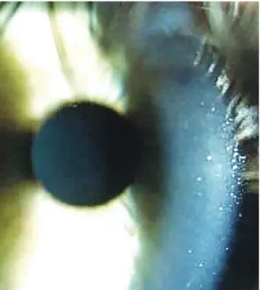 Figure 4: The interface fluid had nearly resolved and recovery of cor- cor-neal transparency is seen obviously after treatment.