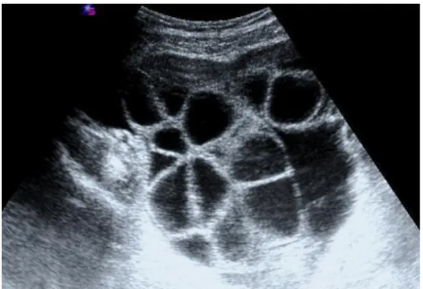 Şekil 1. Ultrasonografide çok sayıda büyümüş folikül 