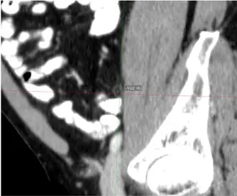Fig 2 .  Contrast Enhanced Computed Tomography  shows the measurement value of the appendix was  calculated as -102 HU, representing fatty infiltration  in the submucosa of the appendix