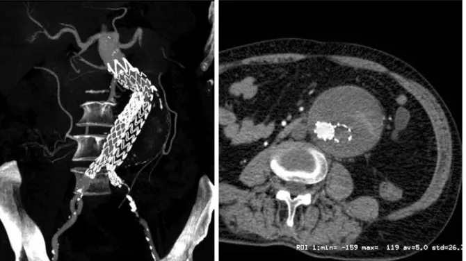 Şekil 4. Sol ana iliyak arterde ileri stenozu olan hastada sol ana iliyak arterde okluder ve femo- femo-ro-femoral bypass: Kontrol bilgisayarlı tomografi anjiyografi reformat görüntüleri.