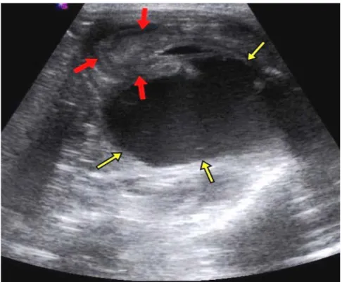 Figure 1: Sagittal US image showed complicated cystic mass which connected to uterus (Red Arrows: Uterus, Yellow Arrows: Vagina).